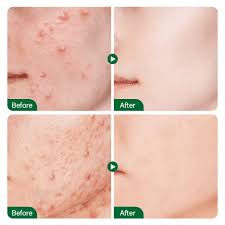 FORT Salicylic Acid Serum – Anti-Acne Face Serum & Dark Spot Correcting Serum for Glowing Skin | Acne Skin Care Products 30ml